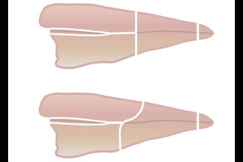 The angle cutting option allows it to follow the curved lines of the bone frame very closely, further reducing pinbone material